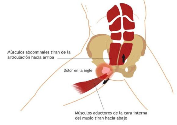 Osteopatía dinámica púbica